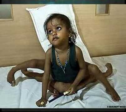 8 limbed baby to have an operation