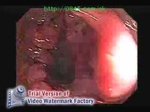 Colonoscopy of a rectal Cancer with Hemorrhoids